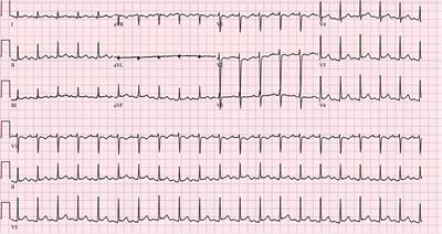 Case Report: Three cases of clinically suspected viral myocarditis with recovery of left ventricular dysfunction